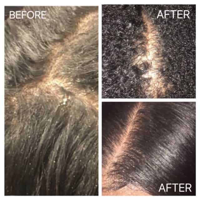 scalp heath after collagen