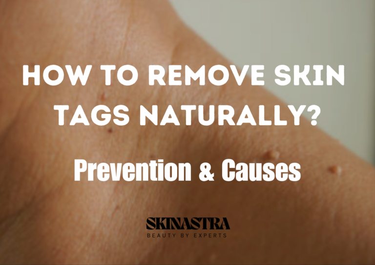 Remove Skin Tags Naturally