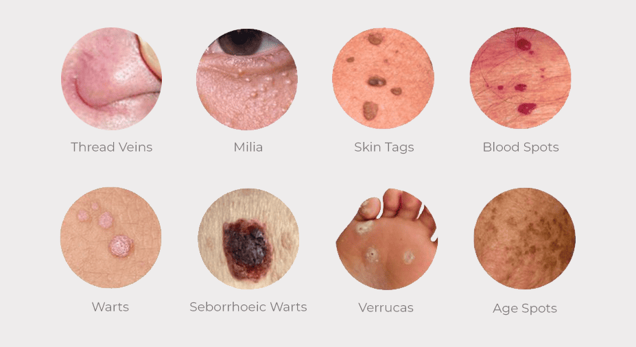 Symptoms and Signs to Look Out for with Skin Tags