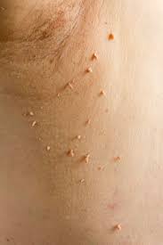 skin tags causes