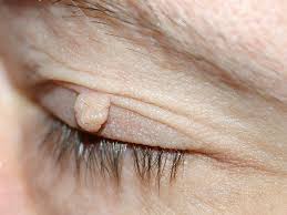 Can Skin Tags On Eyelids Be Removed?